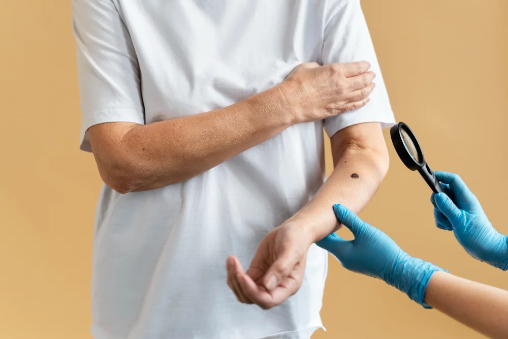 Ayurvedic management of keloids