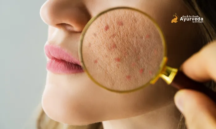 Fungal Acne Treatment in Ayurveda