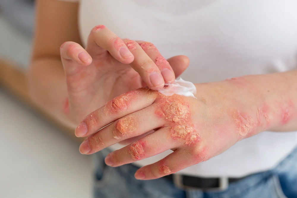 Urticaria Ayurvedic Treatment