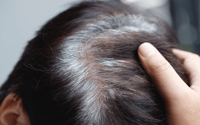 Effective Ayurvedic Treatments for Hair Loss and Early Greying